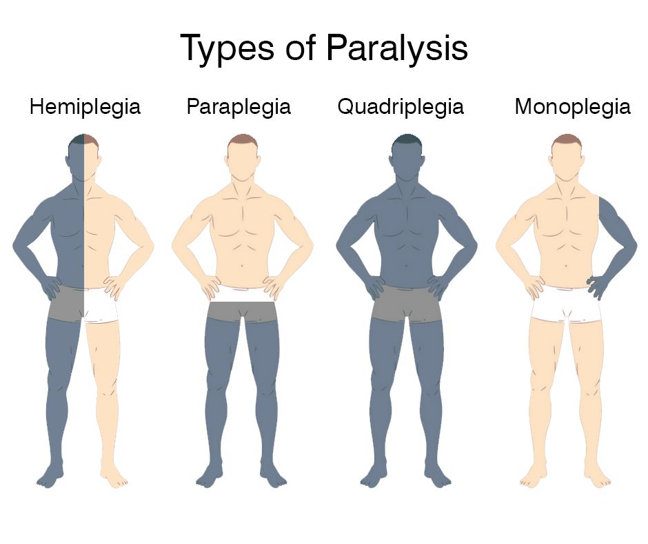 Paraplegie