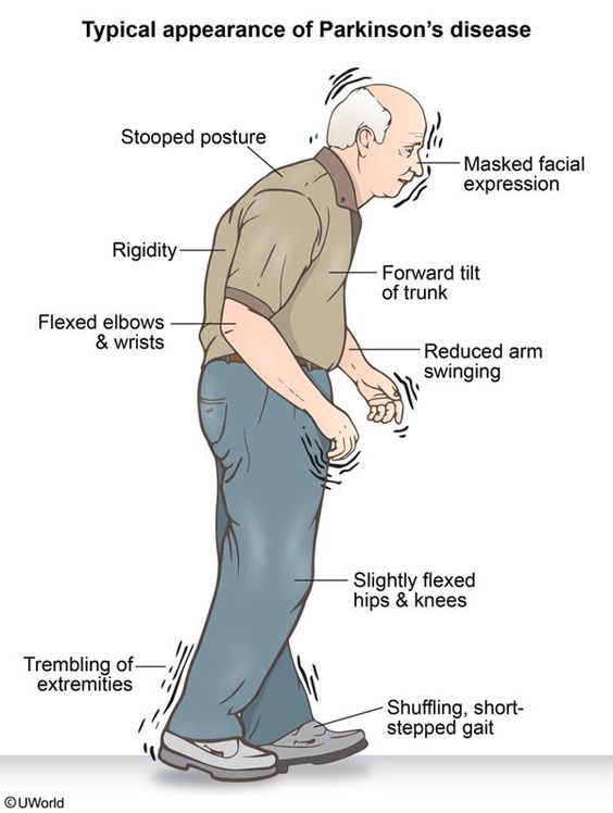 Parkinson-Disease